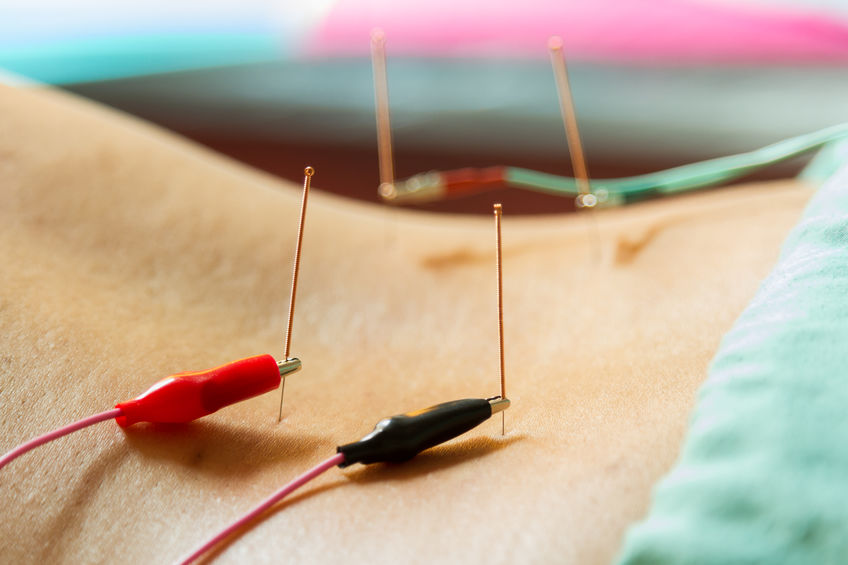 electrical stimuluation acupuncture