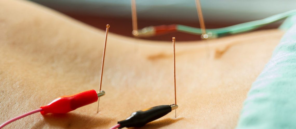 electrical stimuluation acupuncture